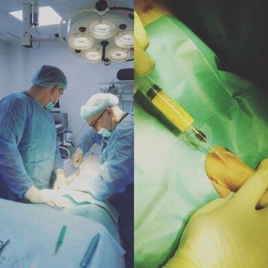 Verdickung vum Penis ass méiglech mat der Hëllef vun der Chirurgie