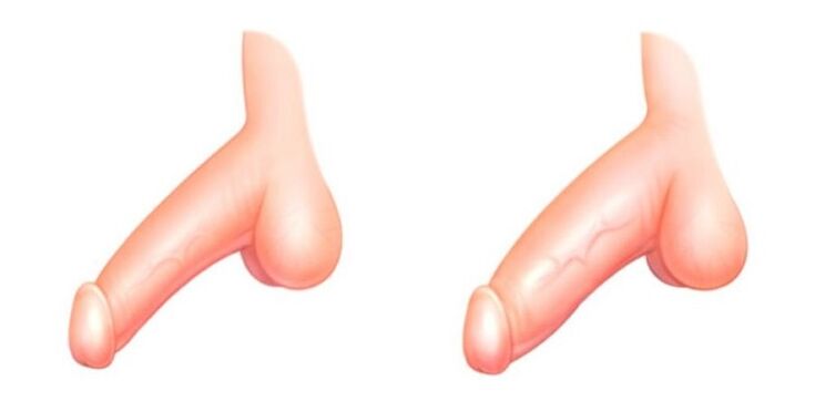 Penis virun an no der Erweiderung